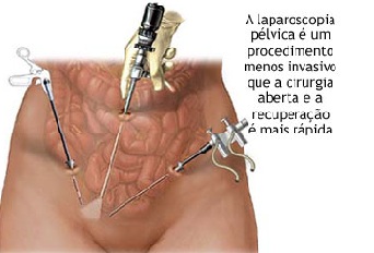 A importância de uma boa recuperação pós-laparoscopia!